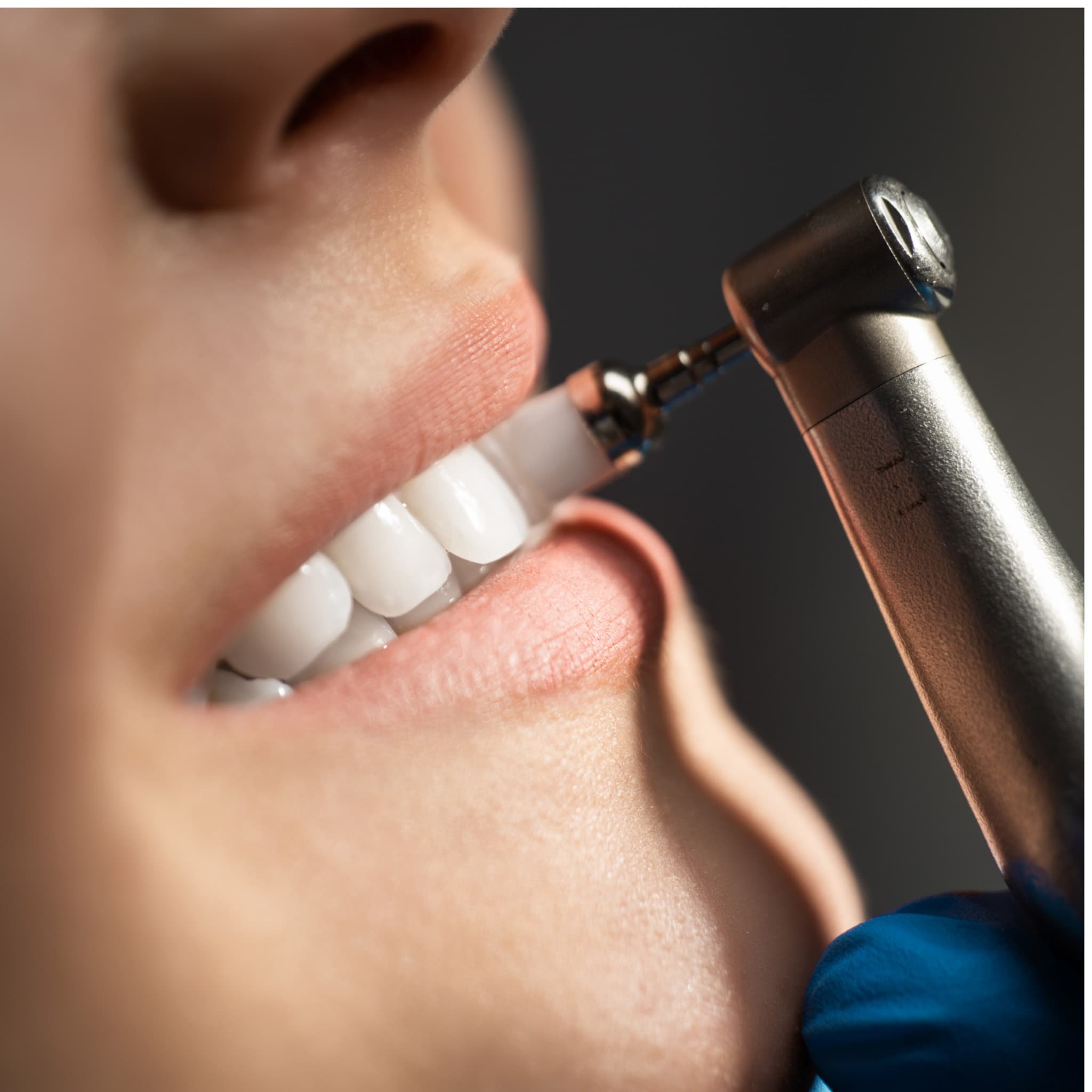 Oral Prophylaxis & Periodontal Treatment