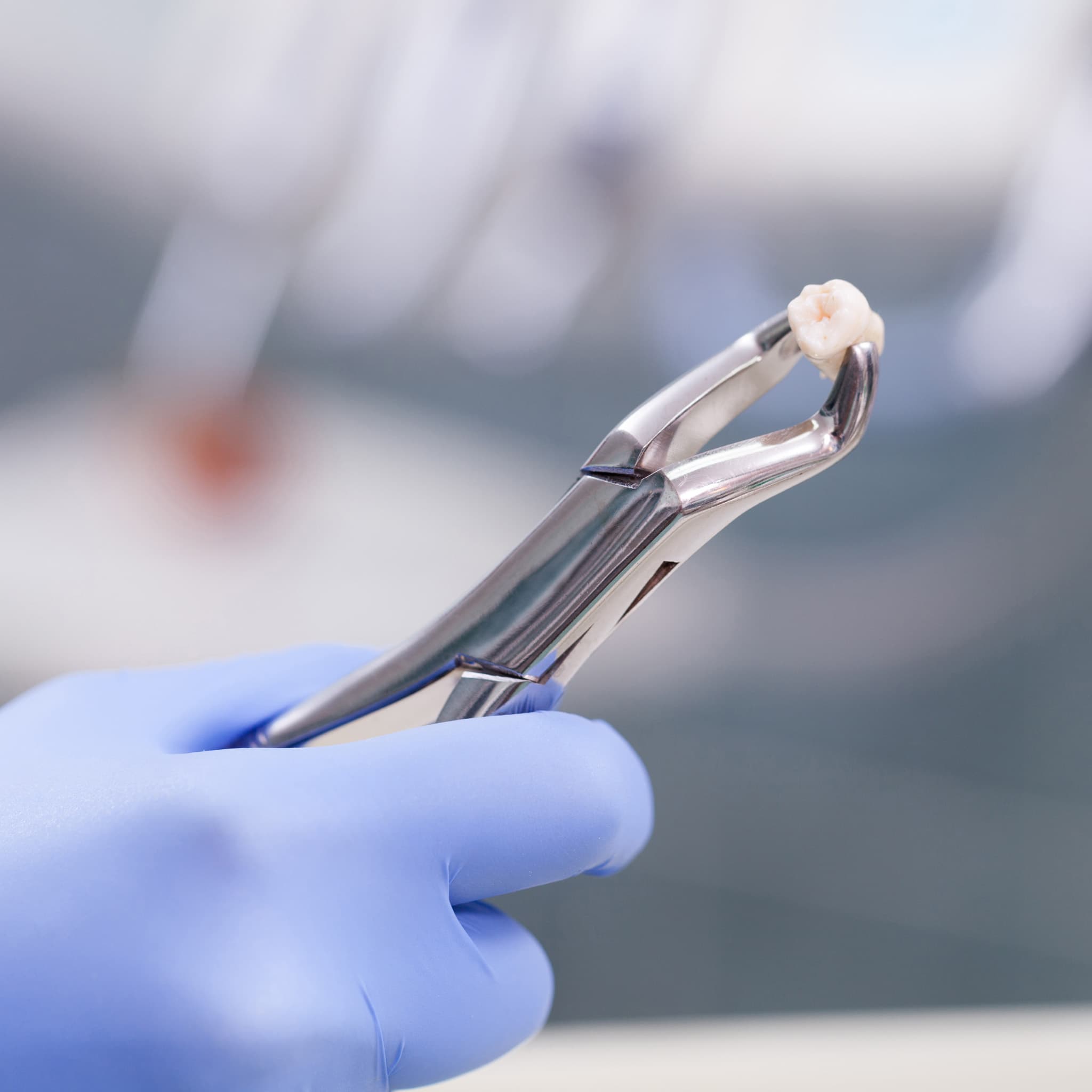 Tooth Extraction (Simple & Complex)