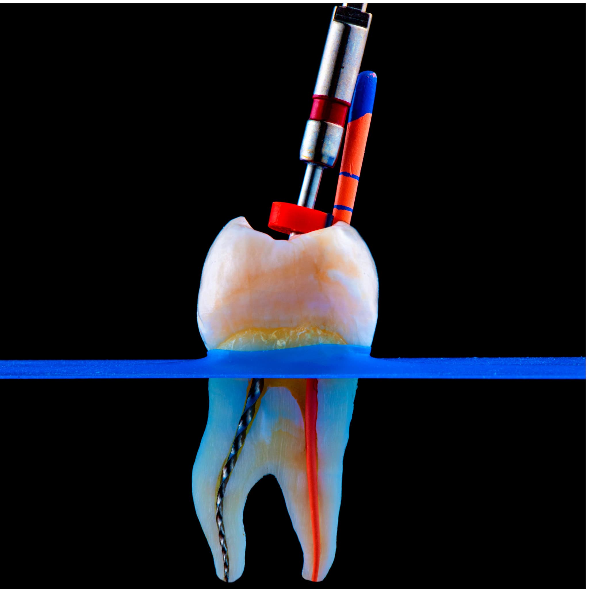 Root Canal Therapy