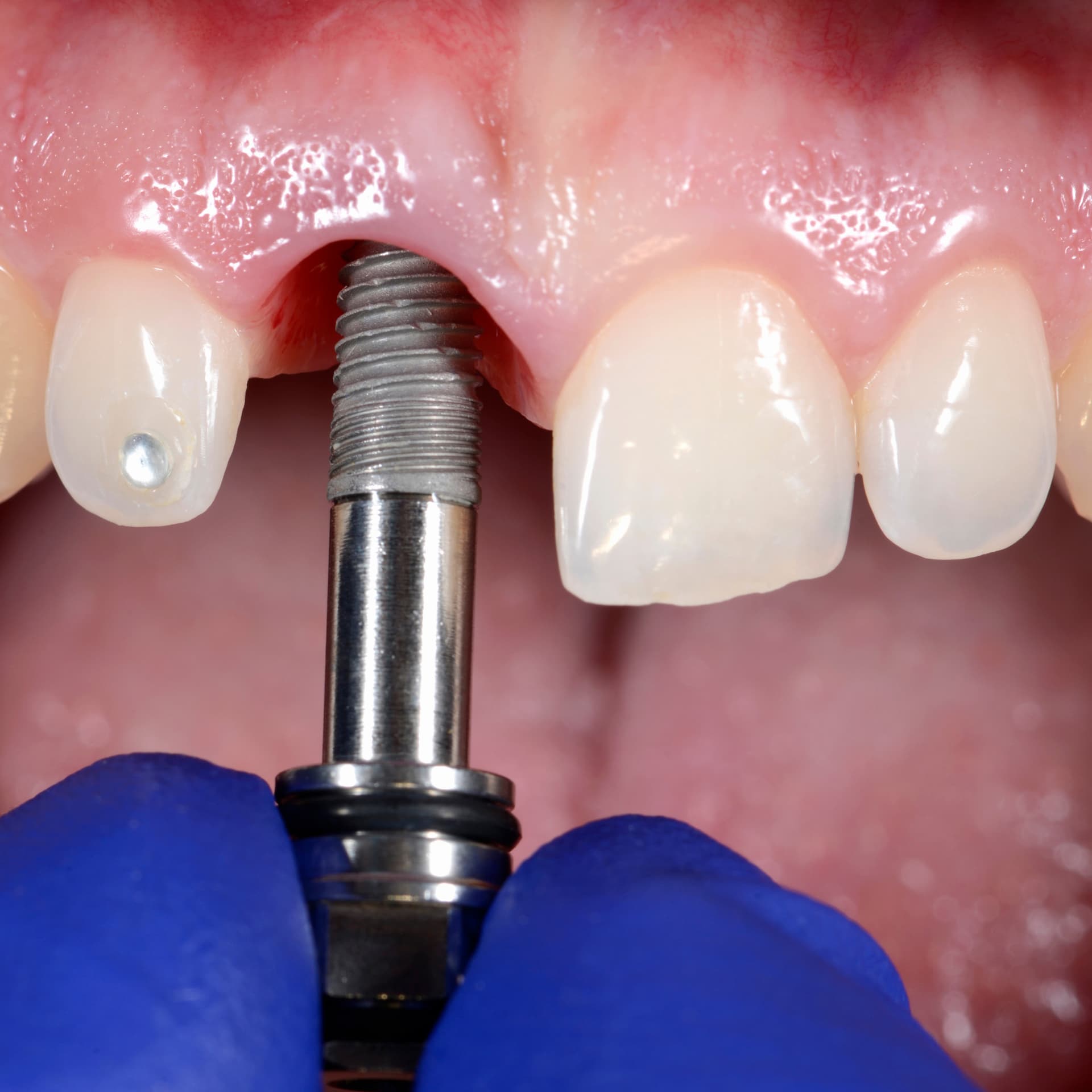 Implant at Prime Oral Dental Clinic