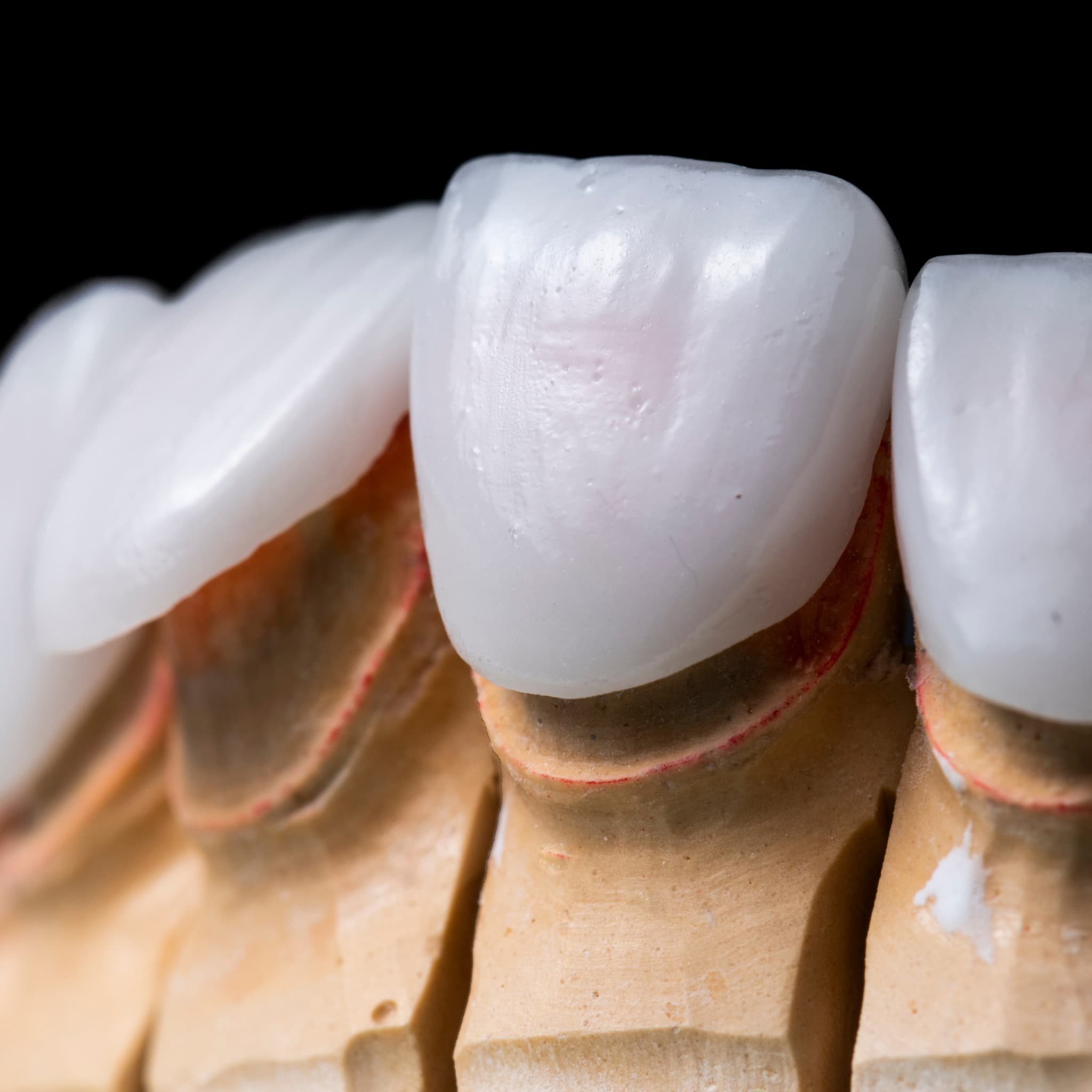 Veneers
