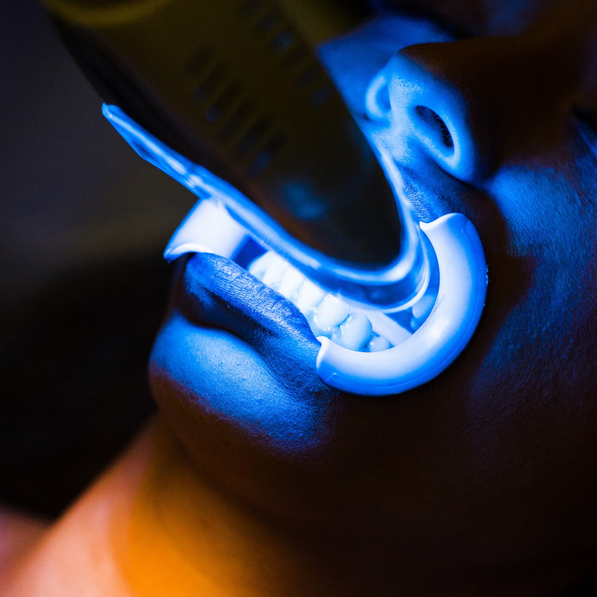 Teeth Whitening